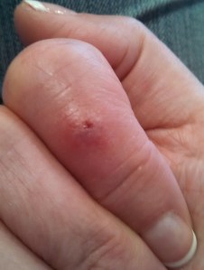 Radioactive genetically engineered spider bite